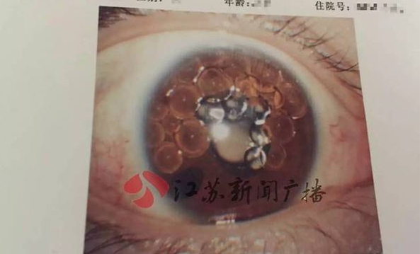 北京:北医三院18人因问题气体单眼失明